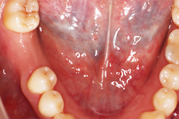 右下6番インプラント術前