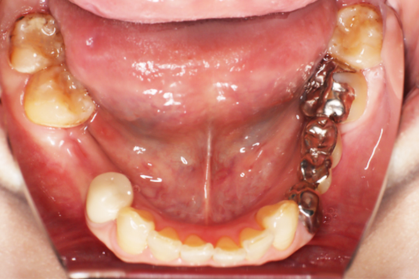 右下6番インプラント術前