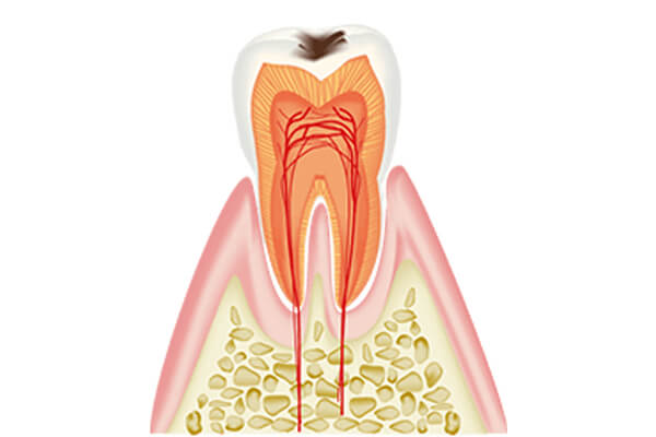 C1(エナメル質の虫歯)