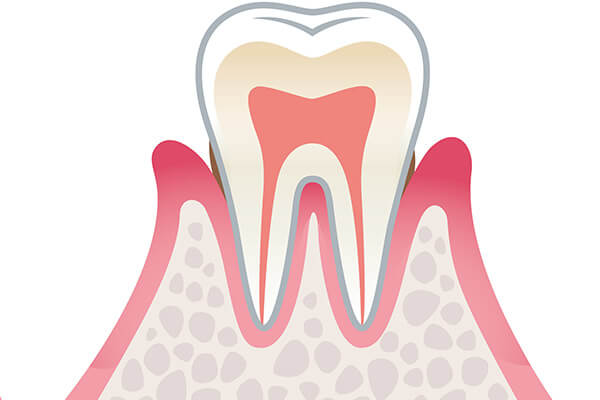 軽度歯周病について
