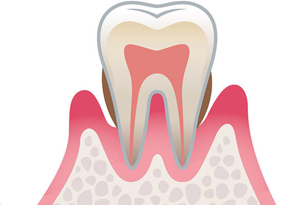 中等度歯周病について