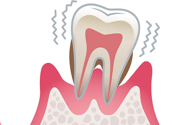 重度歯周病について